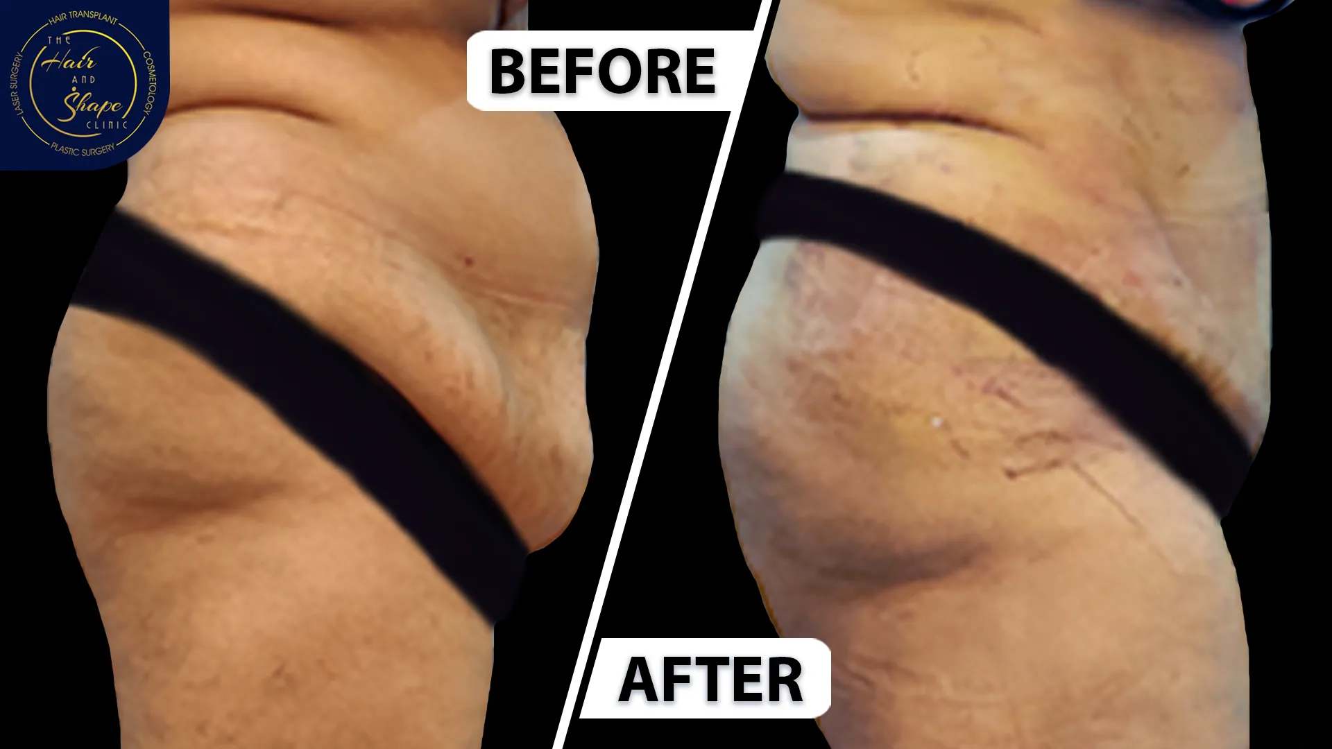 Tummy Tuck result5